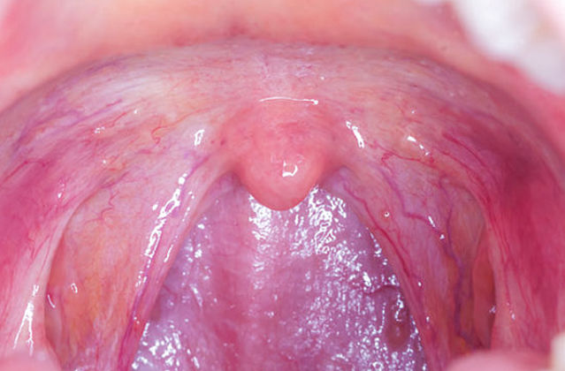 Throat Cancer Oral Sex