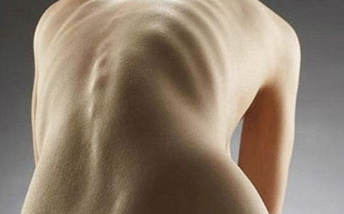 Anorexoria Skinny Naked Women Porn Tube